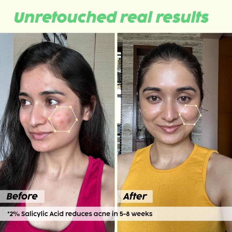 Plix 2% Salicylic Acid Acne Spot Corrector Gel For Reducing Active Acne, Controls Oil and Acne Scars (15 g)