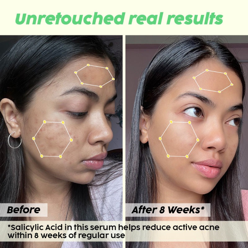 PLIX 2% Salicylic Acid Jamun Active Acne Control Dewy Serum for Active Acne & Dark Spot Reduction (30ml)