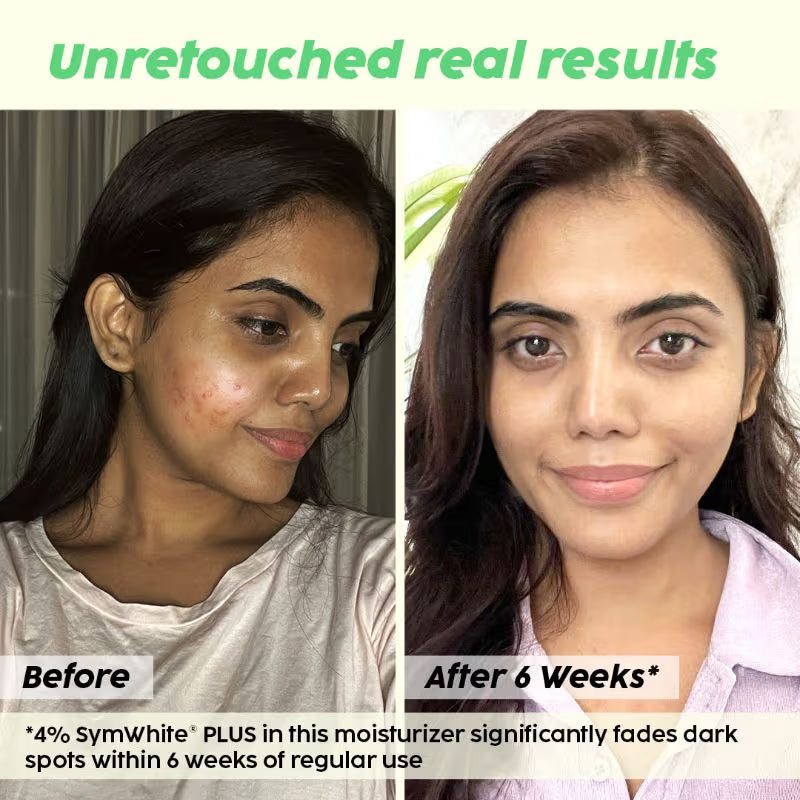 Plix 2% Alpha Arbutin Pineapple Moisturizer With SymWhite PLUS For Hyperpigmentation & Dark Spots (30g)