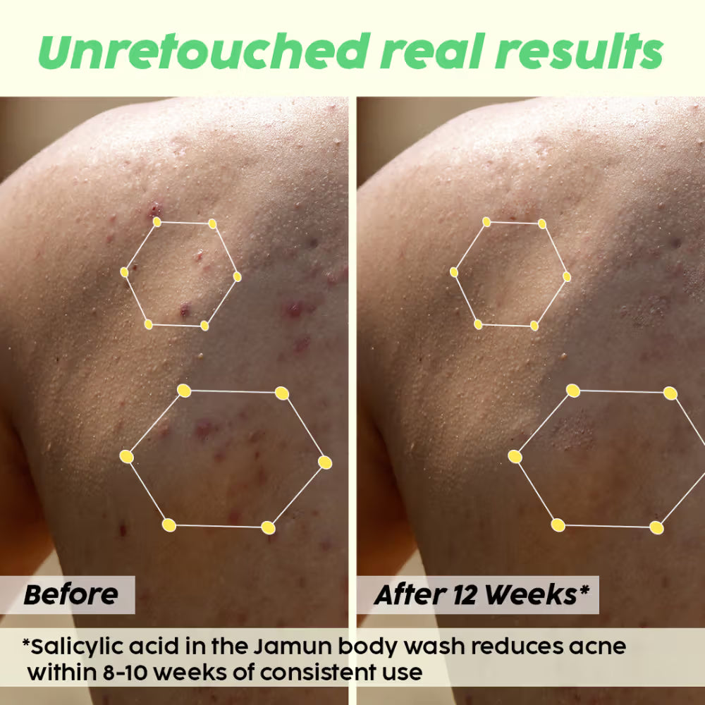Plix 2% Salicylic Acid Body Wash For Body Acne, Deeply Exfoliating Dead Skin Cells, Moisturizes Skin (236ml)
